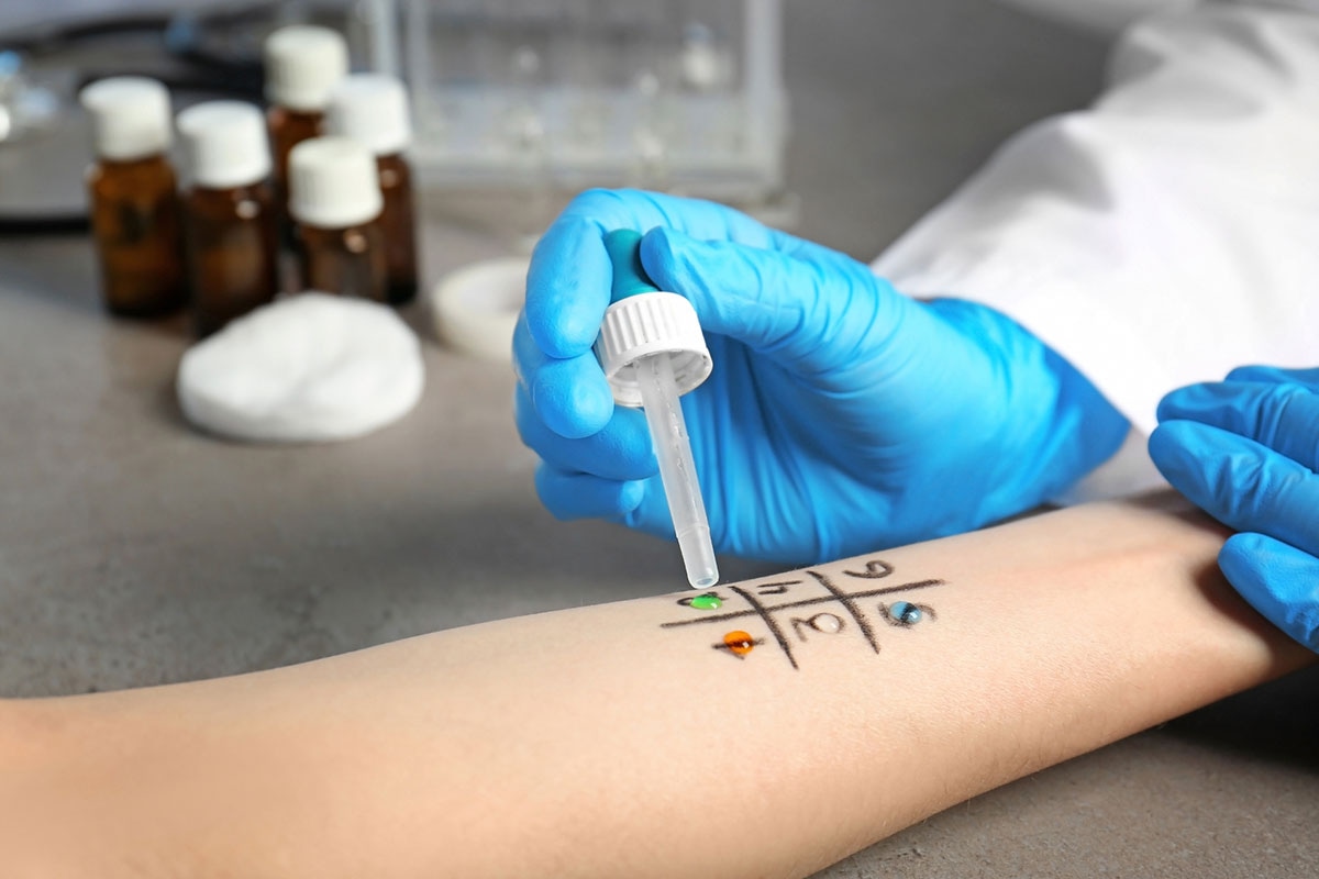 Healthcare professional administering allergy skin prick test on forearm with labeled grid and colored allergen drops