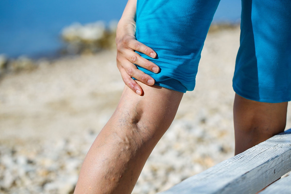 Varicose veins on an older adult's lower leg, a condition covered under ASEBP MyRetiree Plan extended health benefits