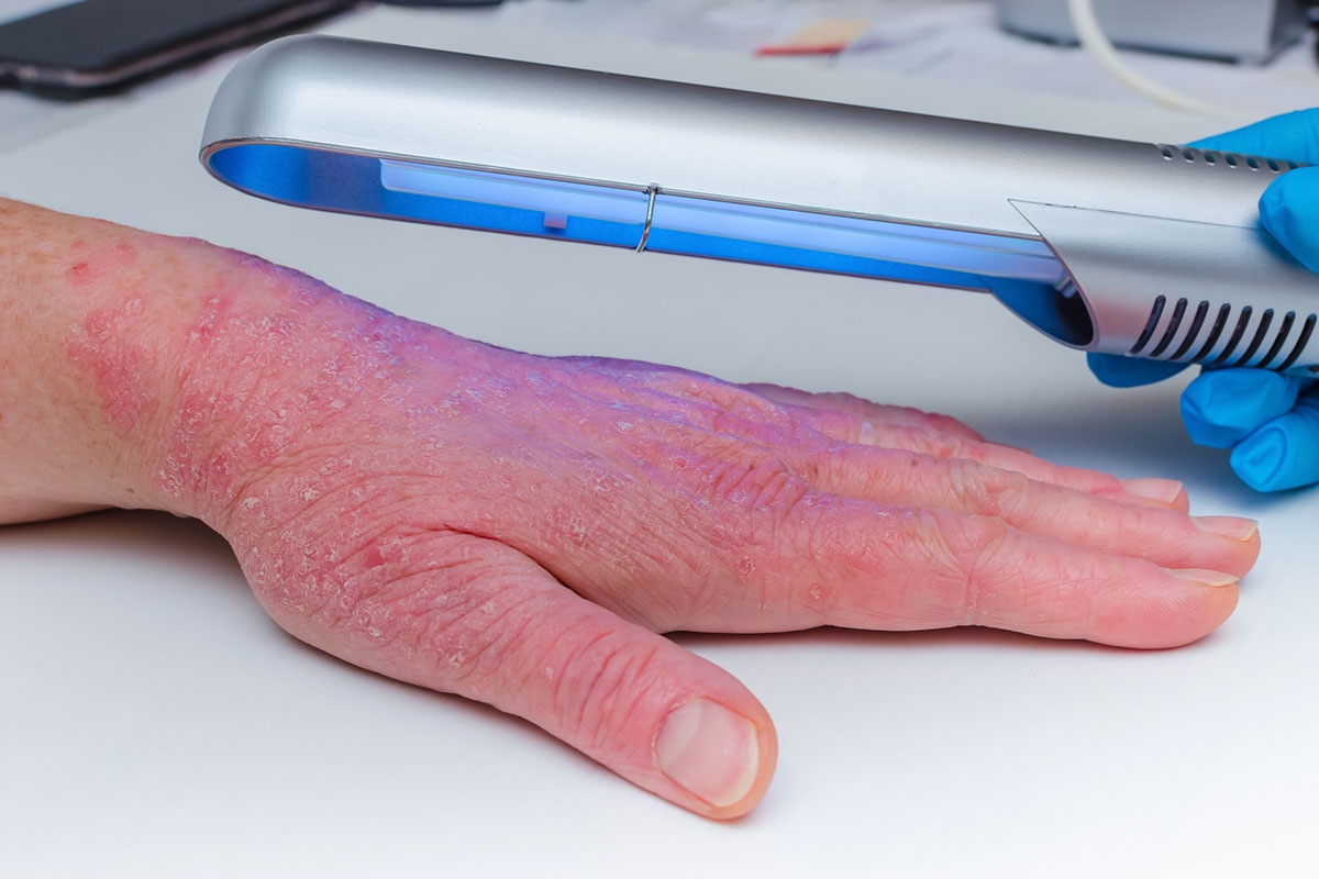 UV light therapy device treating severe psoriasis on a hand, covered under ASEBP MyRetiree Plan extended health benefits
