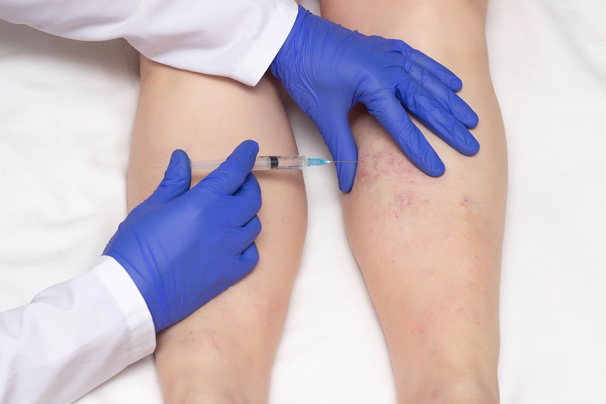 ASEBP MyRetiree Plan covers sclerotherapy drugs for treating spider and varicose veins in retirement